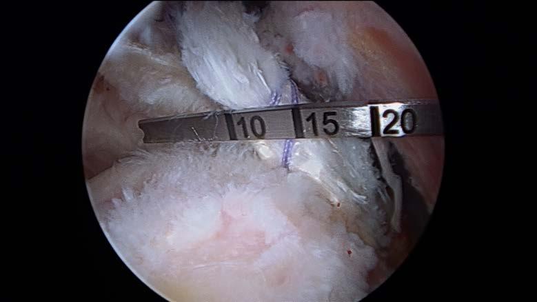 ARTHROSCOPIC BICEPS TENODESIS SURGICAL TECHNIQUE Tendon Preparation 2 1a 1b Option 1: Pull on the traction sutures to remove the biceps tendon through the anterior superior portal.