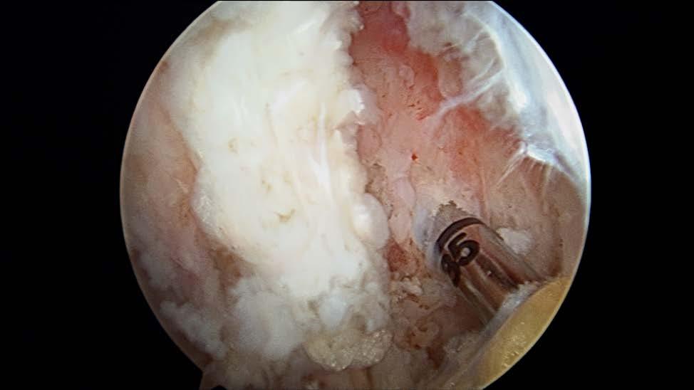Option 2: Alternatively, for an all-arthroscopic technique, place a whipstitch in the proximal end of the tendon with an arthroscopic suture passer.