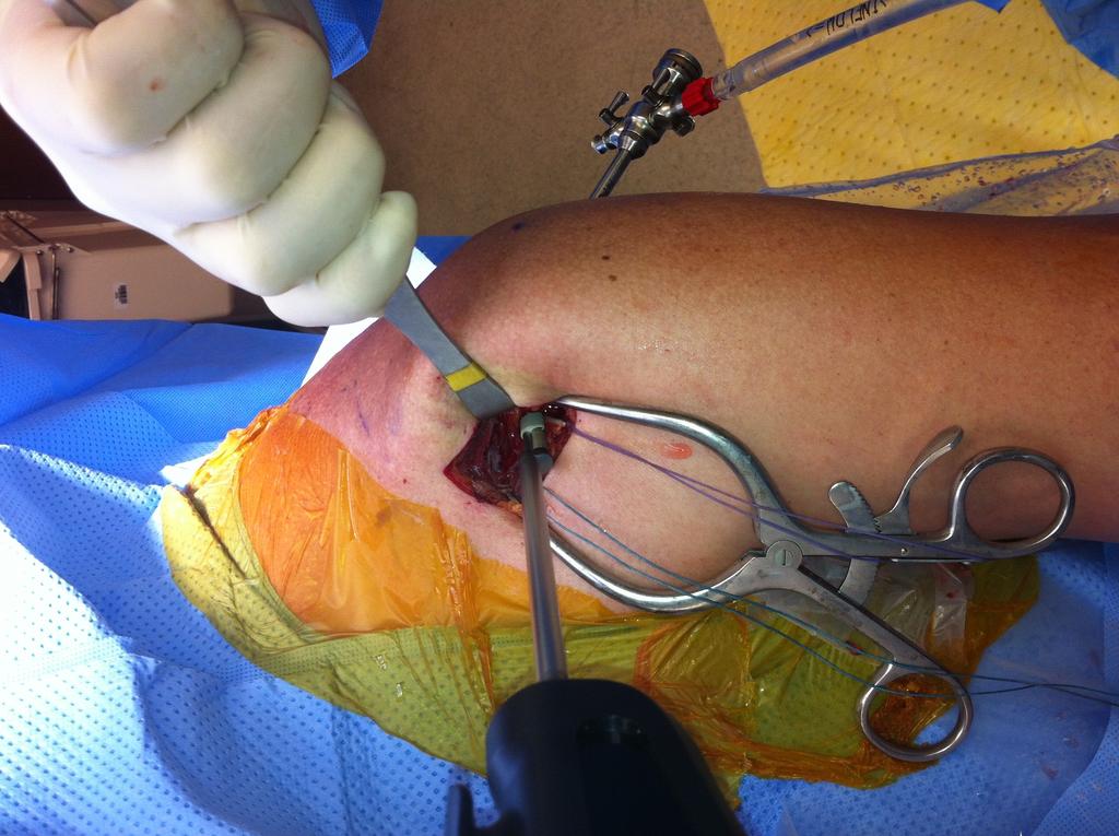 8 SURGICAL TECHNIQUE SUBPECTORAL BICEPS Implant Positioning 4a 4b 4a Position the Implant Sheath in the tunnel so that the compressed profile is adjacent to the tendon.