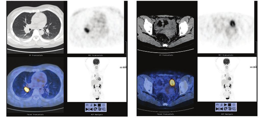 4362 MUSHI et al: OVARIAN METASTASIS FROM NON-SMALL CELL LUNG CANCER A B Figure 1. PET CT diagnosis of ovarian metastasis of lung cancer.