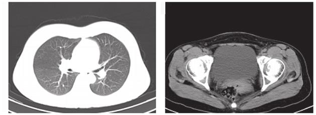 PET CT, positron emission tomography computed tomography. A B Figure 2. The response of the primary disease and ovarian metastasis on CT scan following Tarceva treatment.