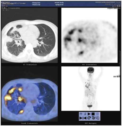 PET CT of the whole body was also performed, which showed high metabolic signals on the right lung and right supraclavicular lymph node (Fig. 4).