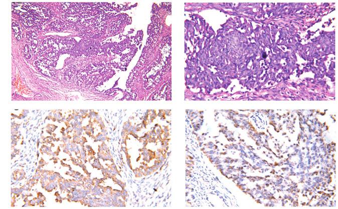 4364 MUSHI et al: OVARIAN METASTASIS FROM NON-SMALL CELL LUNG CANCER A B C D Figure 6.