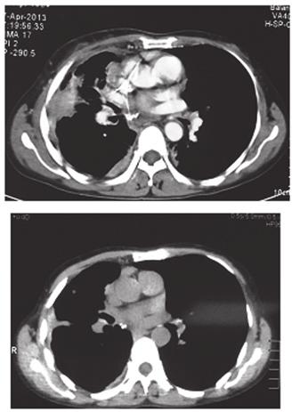 (A) Computed tomography scan of the chest after multiple lines of treatment. (B) PR after crizotinib treatment. Figure 7. Right breast biopsy.