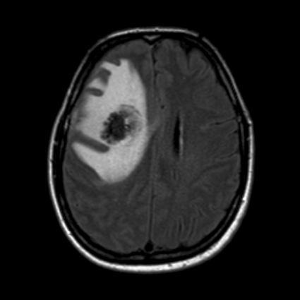 M1 - brain MST 2 6 months