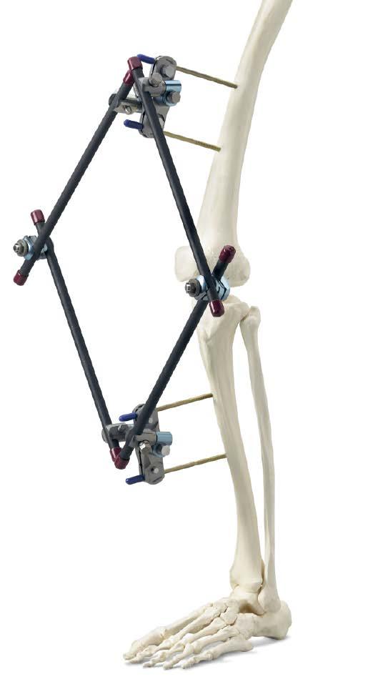 Optional Frame Configuration Enhancing the frame for additional stability Construct medial frame Connect multi-pin clamps with two carbon fiber rods and a combination clamp on the medial side.