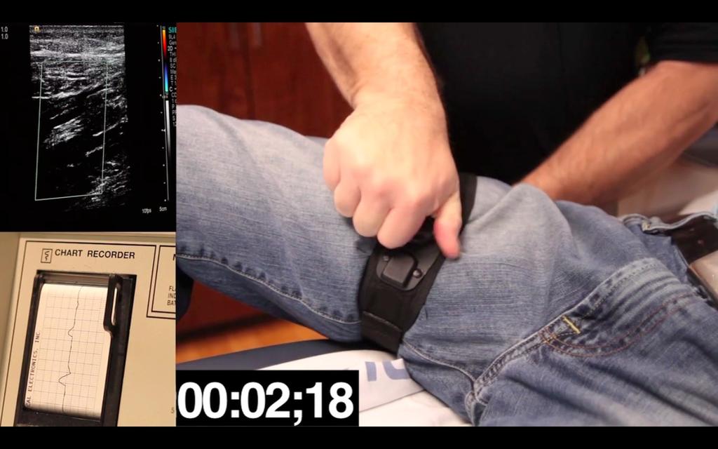 Wade was able to attain complete femoral artery occlusion in 2.1 seconds with the SAVE Tourniquet. (after strap securement) Secure the strap In contrast, it took Dr.