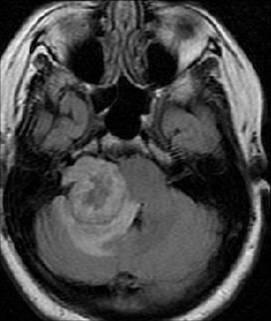 Sturge-Weer syndrome, congenitl neurocutneous syndrome chrcterized y the ssocition of ipsilterl fcil ngiom in the distriution of the trigeminl nerve with leptomeningel ngiomtosis [23-24].