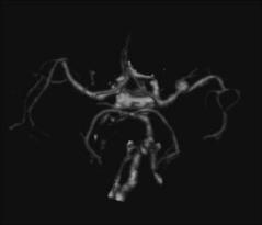 FIGURE 2. 3D reconstruction mximum intensity projection [MIP] of circle of Willis CT ngiogrphy demonstrtes left middle cererl rtery [MCA] neurysm (rrow).