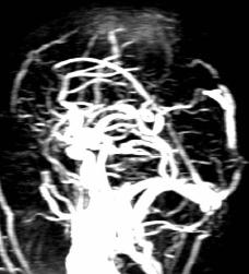A n MR venogrphy (MRV), with or without contrst; or CT venogrphy with contrst lso help in the visuliztion of the sinus thromosis (Figure 5) [10].