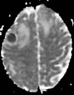 c FIGURE 11. Axil T 2 STIR shows ring lesion in the right frontl loe with surrounding edem.