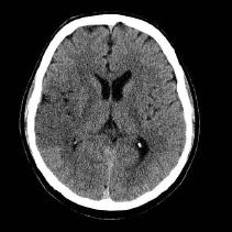 HEAD TRAUMA Hed trum is the most common cuse of deth in young dults. Erly neuroimging hs n importnt role in evluting the extent nd severity of injury.