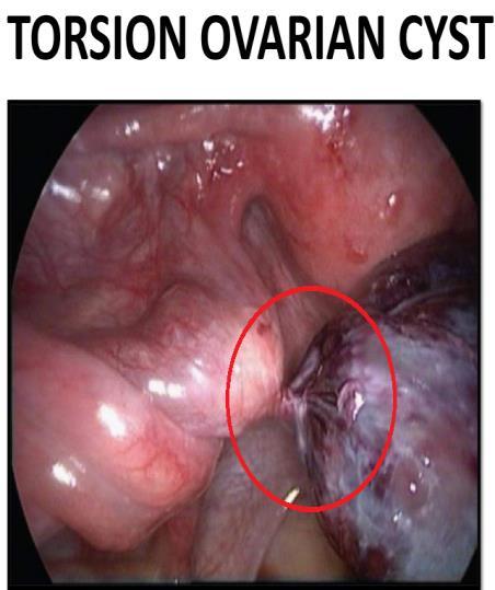OVARIAN PATHOLOGY FOLLICULAR AND LUTEAL CYSTS They are Very common and most of them are benign with Unruptured Graafian follicular cyst.