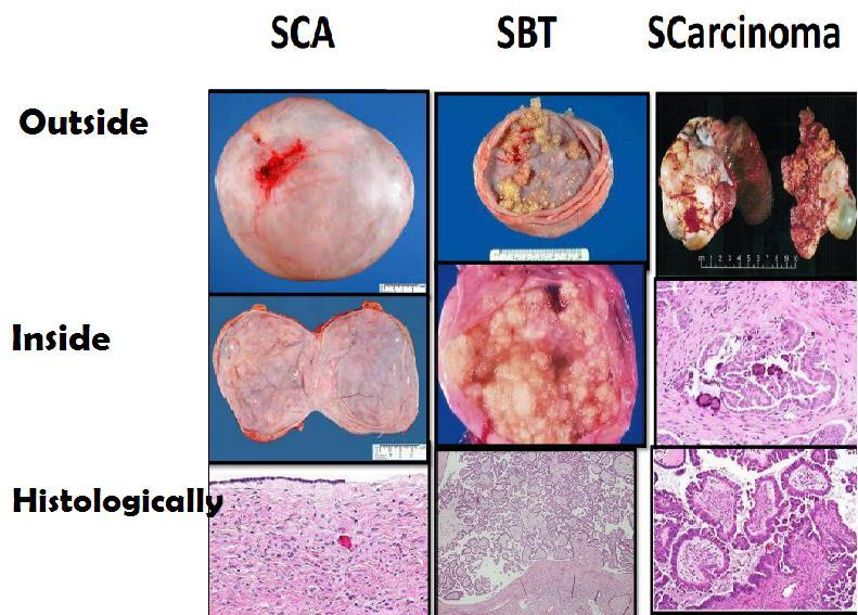 2) Serous tumors Types Serous cystadenoma Borderline serous Serous Carcinoma (SCA) tumors (SBT) Outside shape Shiny Smooth, Nodular irregularity Smooth shiny Inside shape Clear fluid Solid,