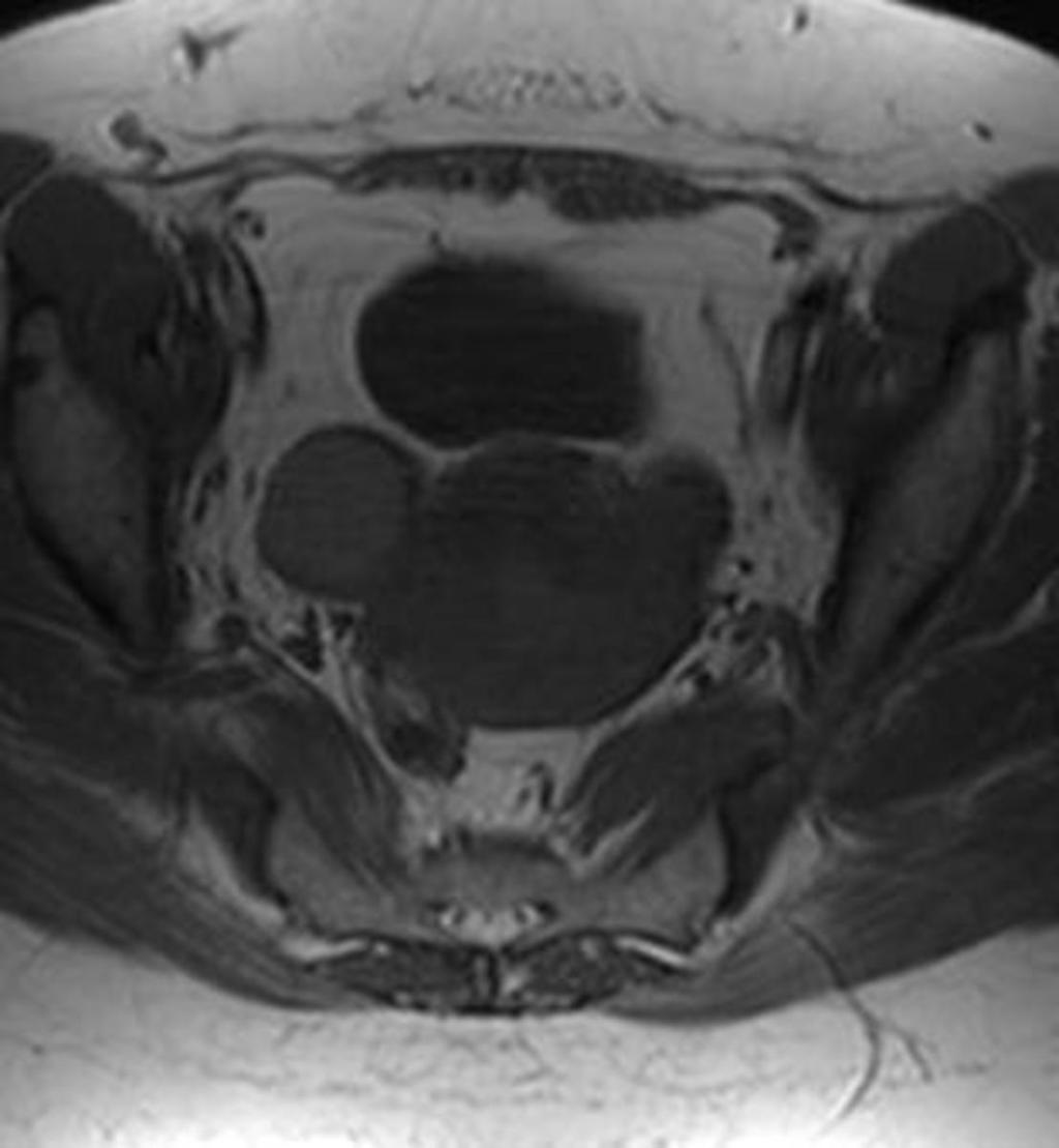 Fig. 7: A 41-year-old patient with an endometrioma of the right ovary.