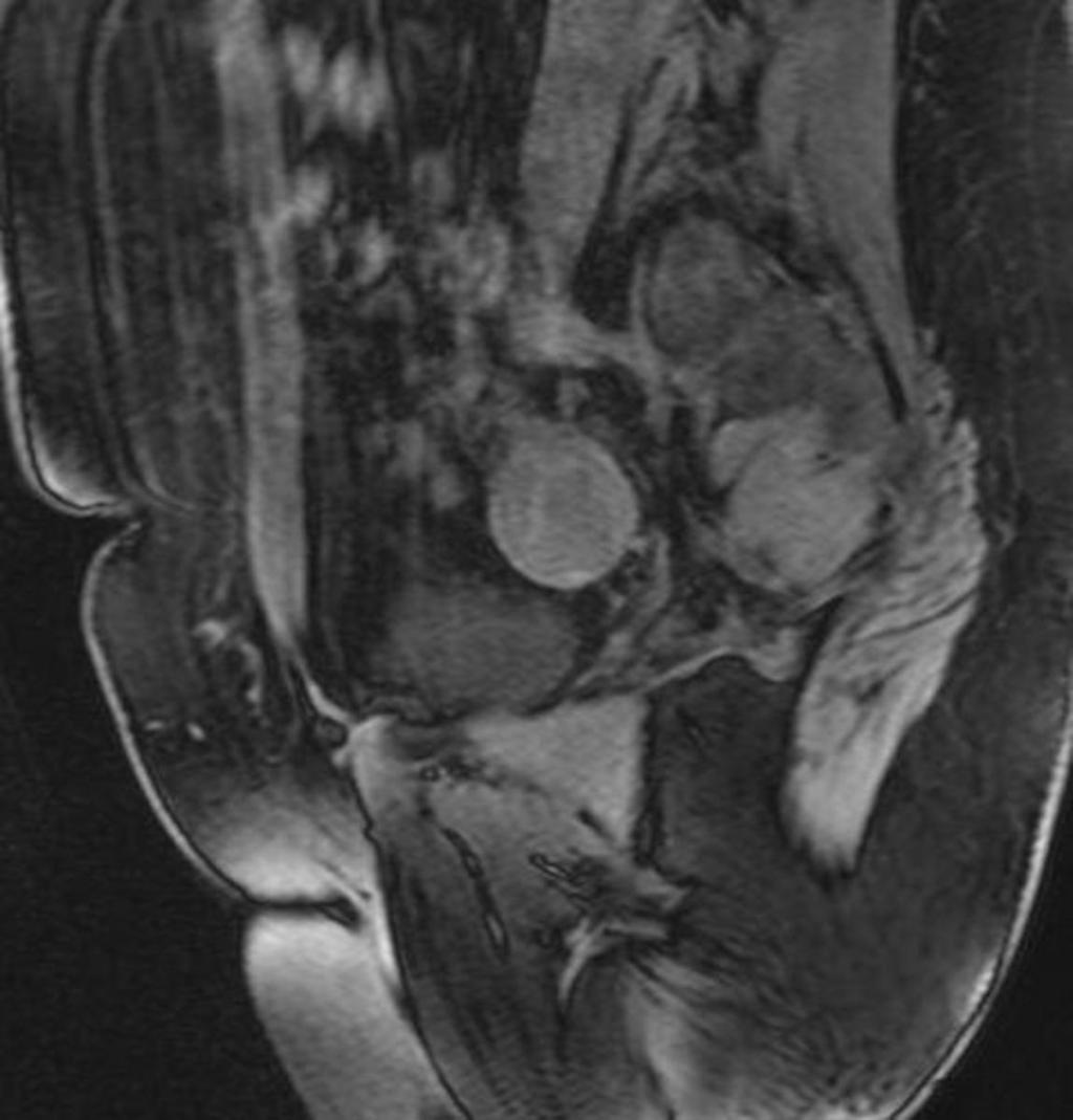 Fig. 9: A 41-year-old patient with an endometrioma of the right ovary.