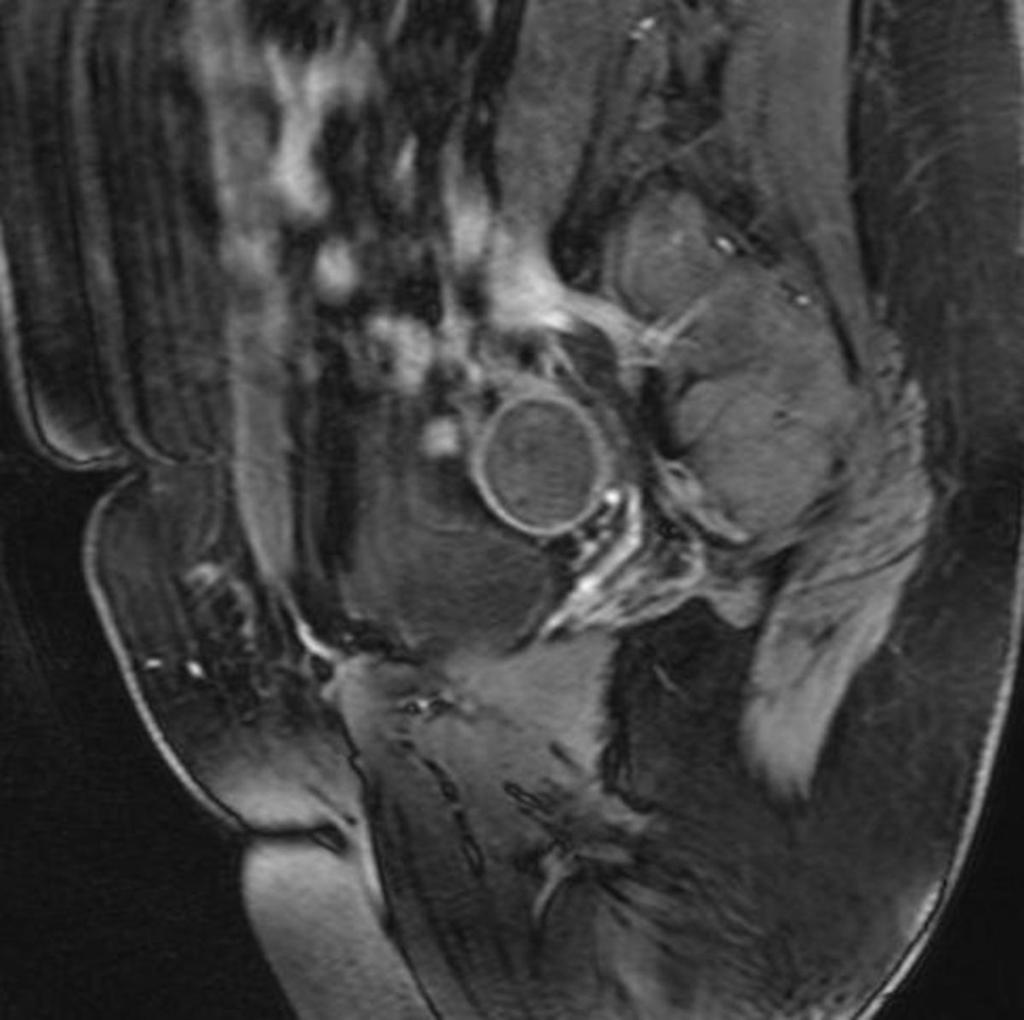 Fig. 10: A 41-year-old patient with an endometrioma of the right ovary. Sagittal #1weighted FS.