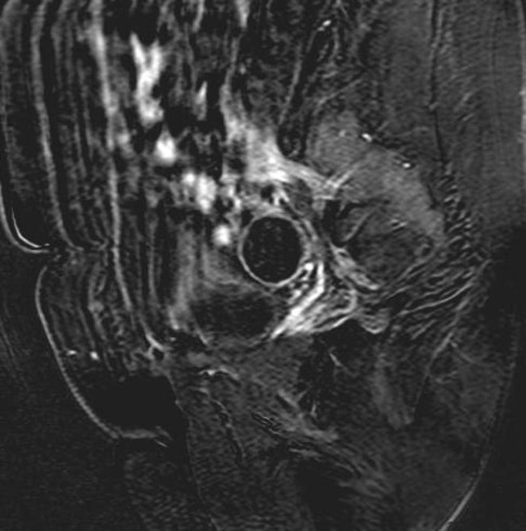 Fig. 11: A 41-year-old patient with an endometrioma of the right ovary. Sagittal #1weighted FS.