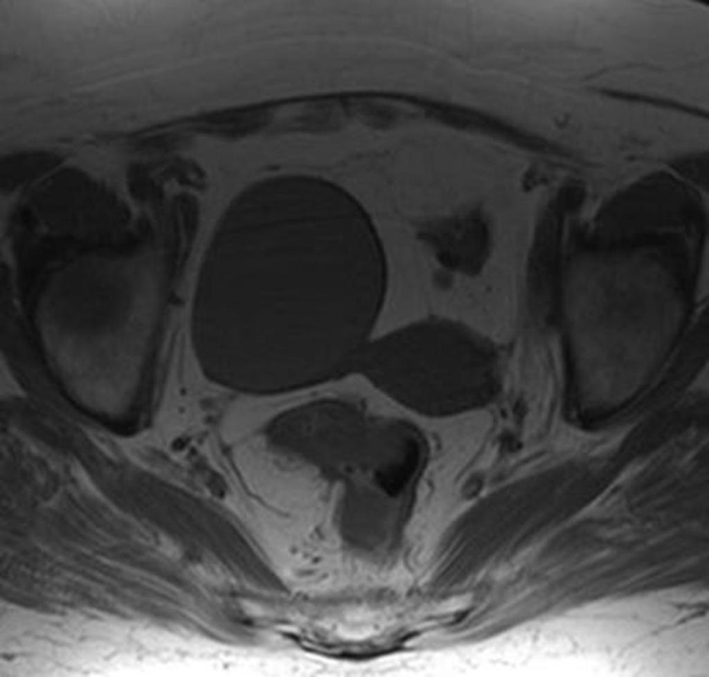 Fig. 12: The 41-year-old patient with an endometrioma of the right ovary at 18-month