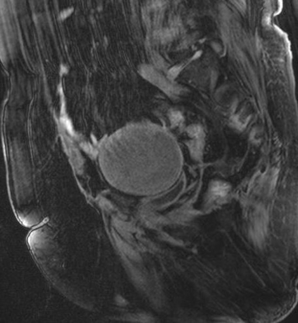 Fig. 14: The 41-year-old patient with an endometrioma of the right ovary at 18-month follow-up.