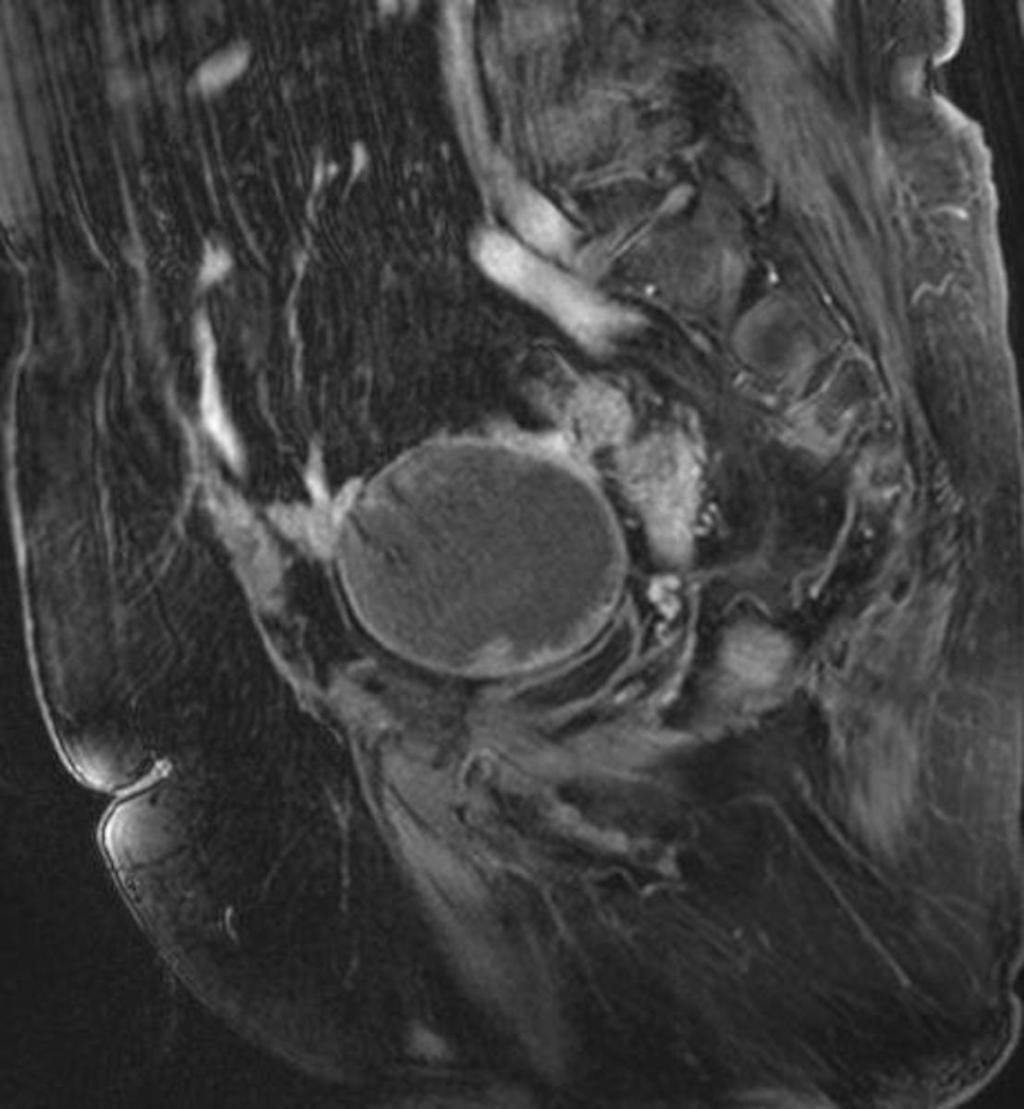 Fig. 15: The 41-year-old patient with an endometrioma of the right ovary at 18-month follow-up.