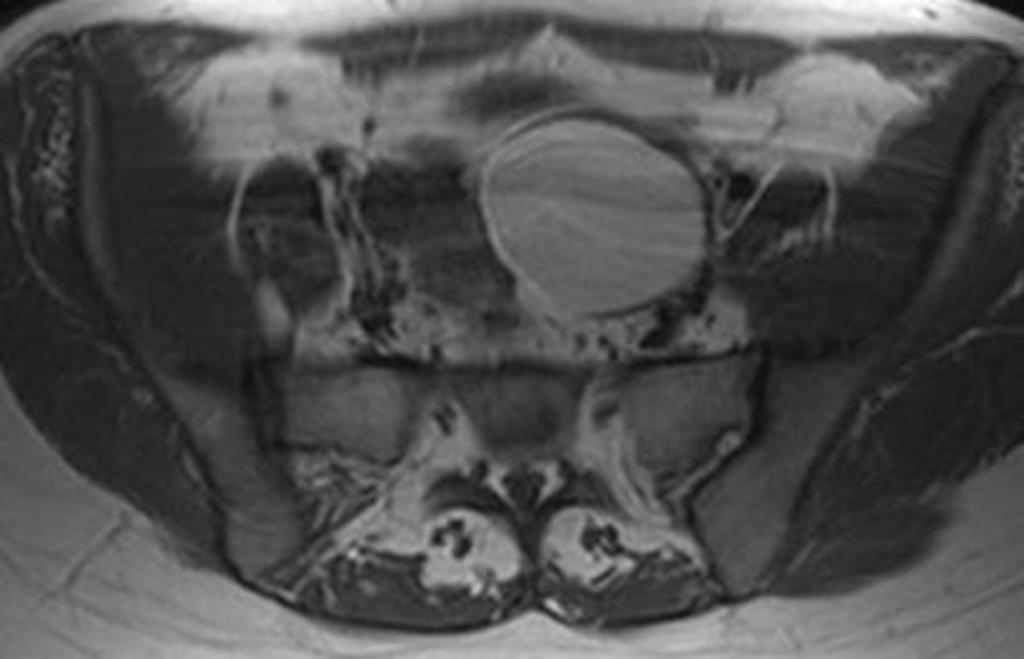 Fig. 16: A 37-year-old patient with endometrial cyst of left ovary.