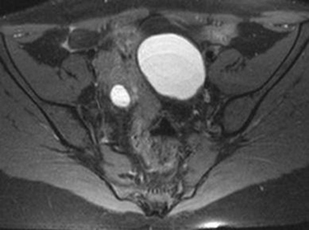Fig. 17: A 37-year-old patient with endometrial cyst of left ovary.