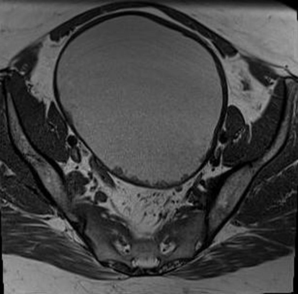 Fig. 19: A 37-year-old patient with endometrial cyst of left ovary at 36-month follow-up.