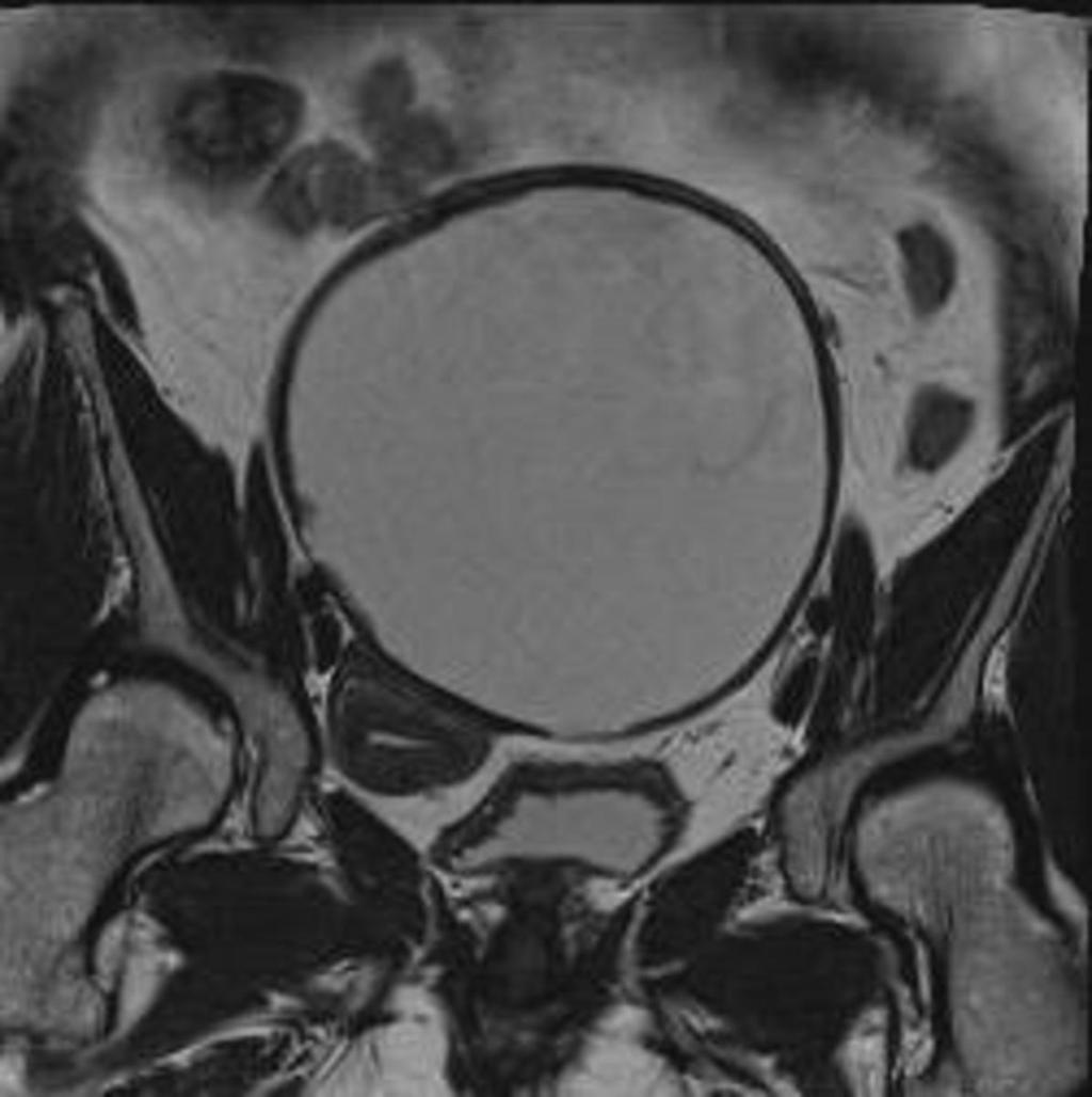 Fig. 21: A 37-year-old patient with endometrial cyst of left ovary at 36-month follow-up.