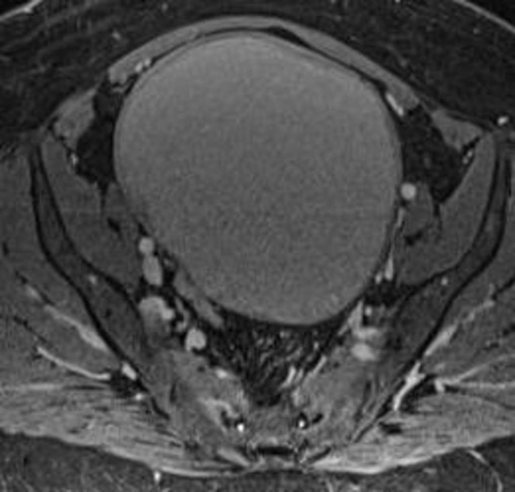 Fig. 22: A 37-year-old patient with endometrial cyst of left ovary at 36-month follow-up.