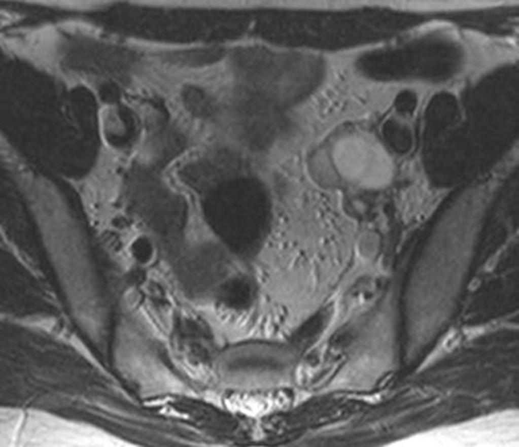 Fig. 24: A 29-year-old patient with an endometrial cyst of left ovary.