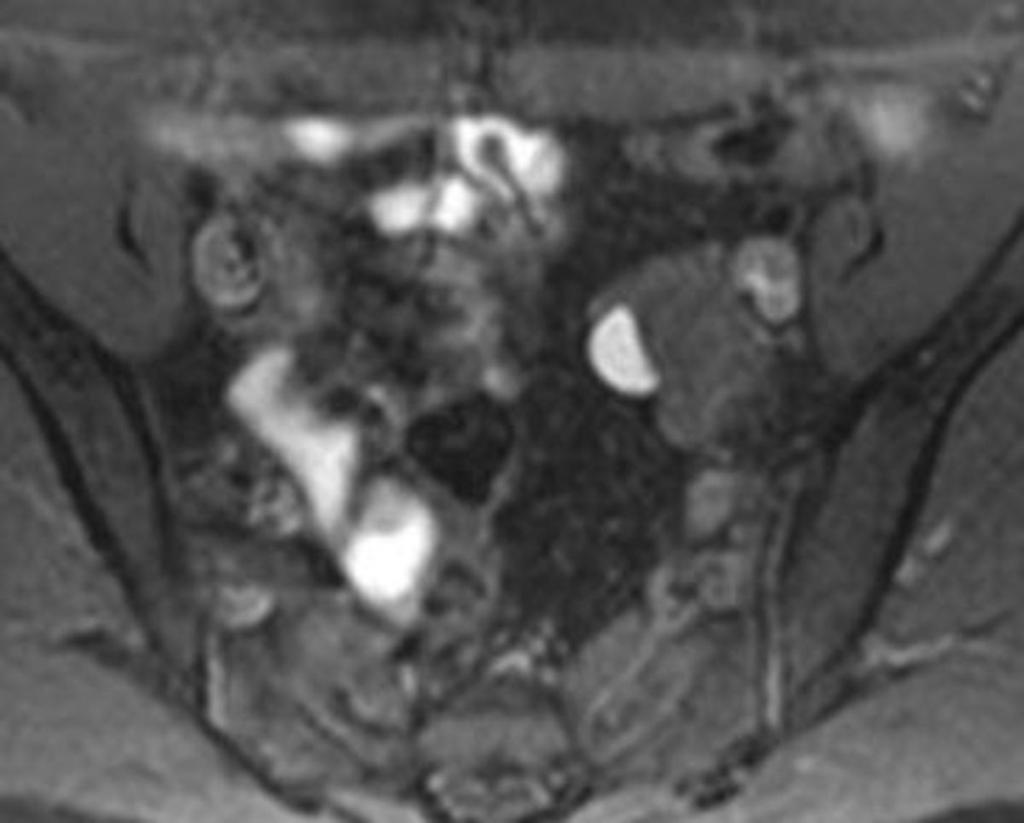 Fig. 25: A 29-year-old patient with an endometrial cyst of left ovary.