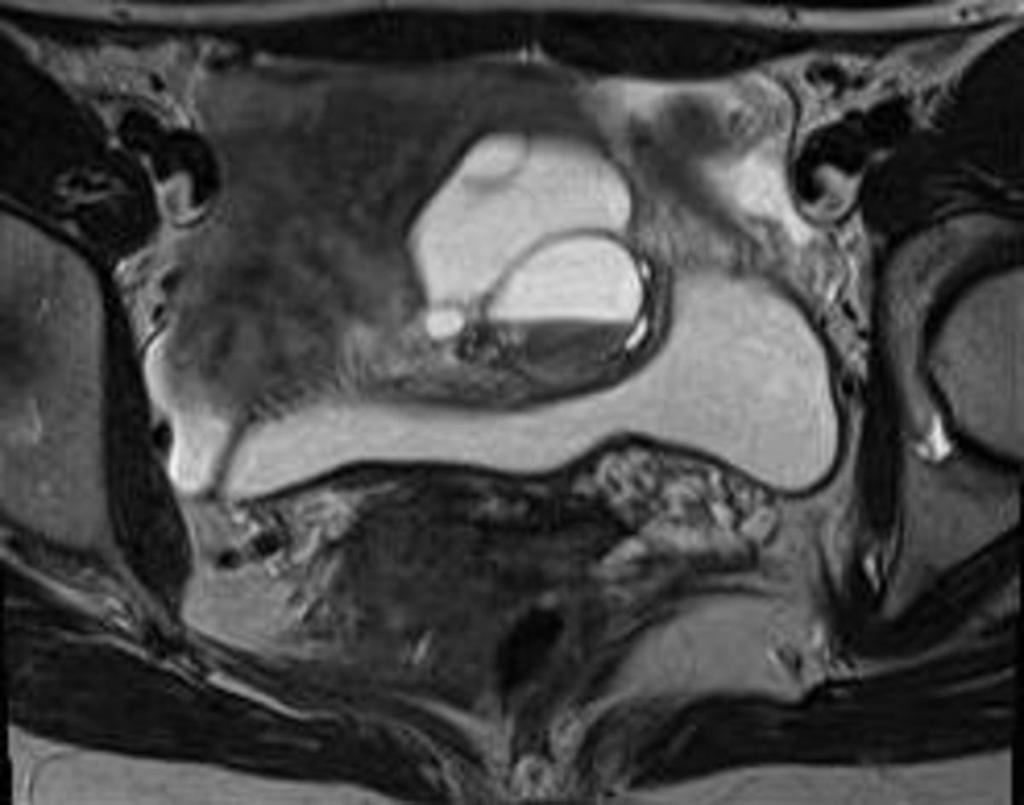 Fig. 26: A 29-year-old patient with an endometrial cyst of left ovary at 12-month followup.