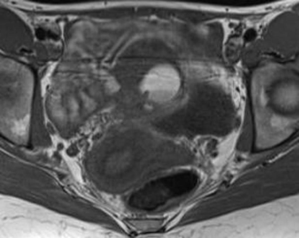 Fig. 27: A 29-year-old patient with an endometrial cyst of left ovary at 12-month follow-up.