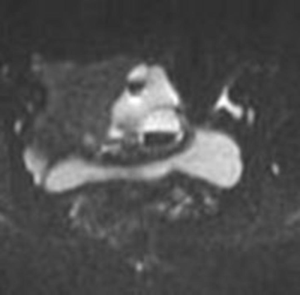 Fig. 28: A 29-year-old patient with an endometrial cyst of left ovary at 12-month followup.