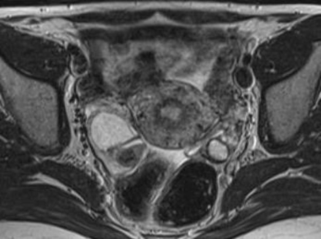 Fig. 29: Axial T2-weighted image. The endometrial cysts of both ovaries.