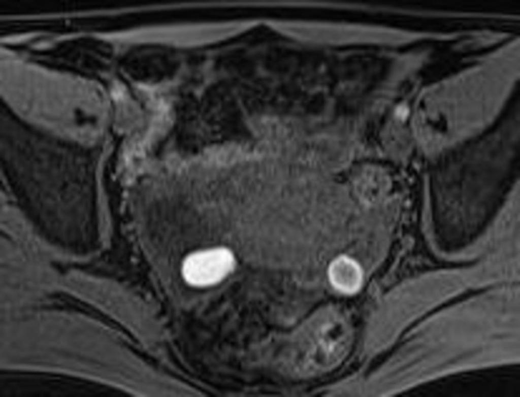 Fig. 30: Axial T1-weighted image with fs.the endometrial cysts of both ovaries hyperintense sygnal.