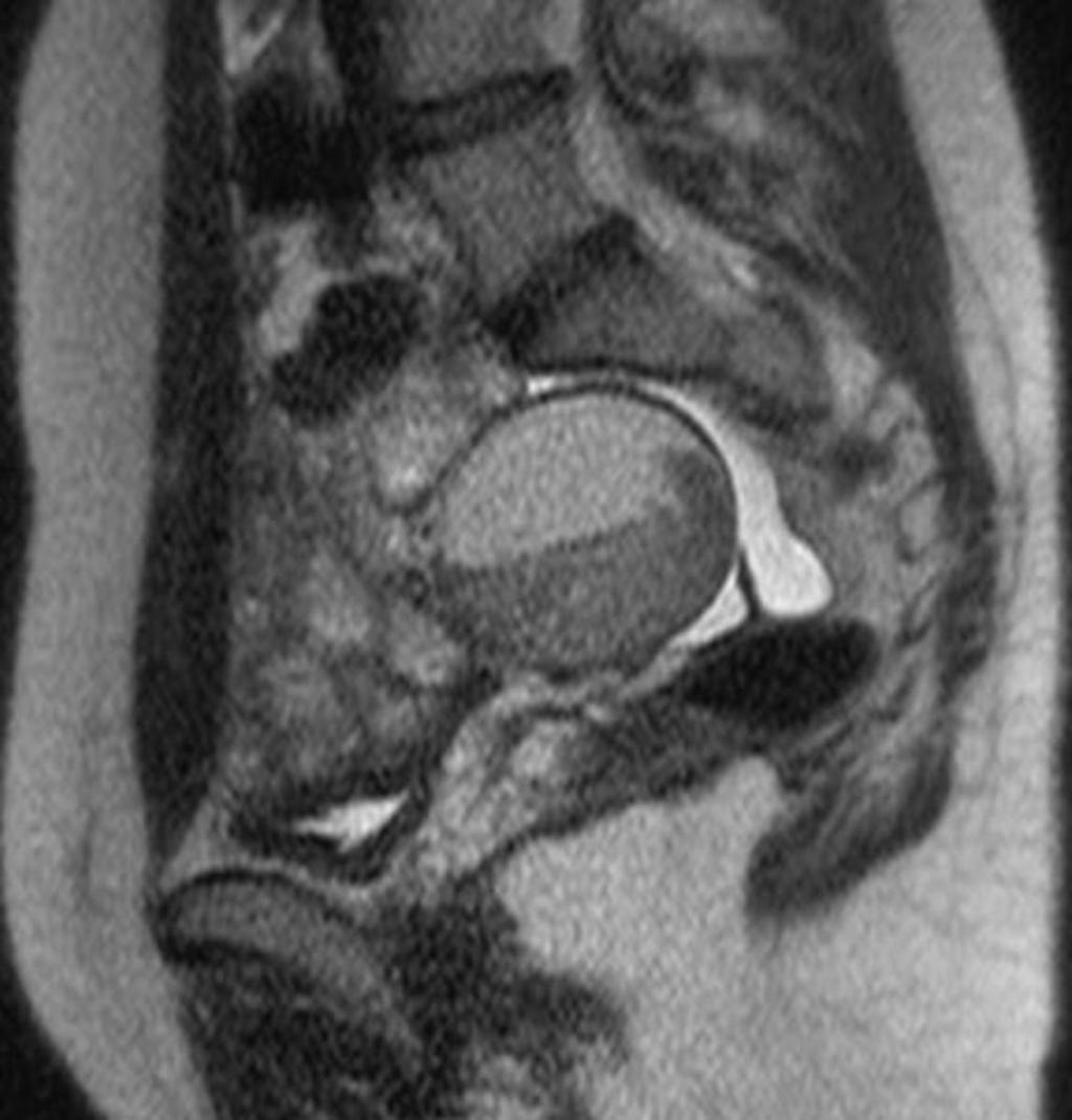 Fig. 32: Teratoma with the hemorrhage. Sagittal #2-weighted image show teratoma.