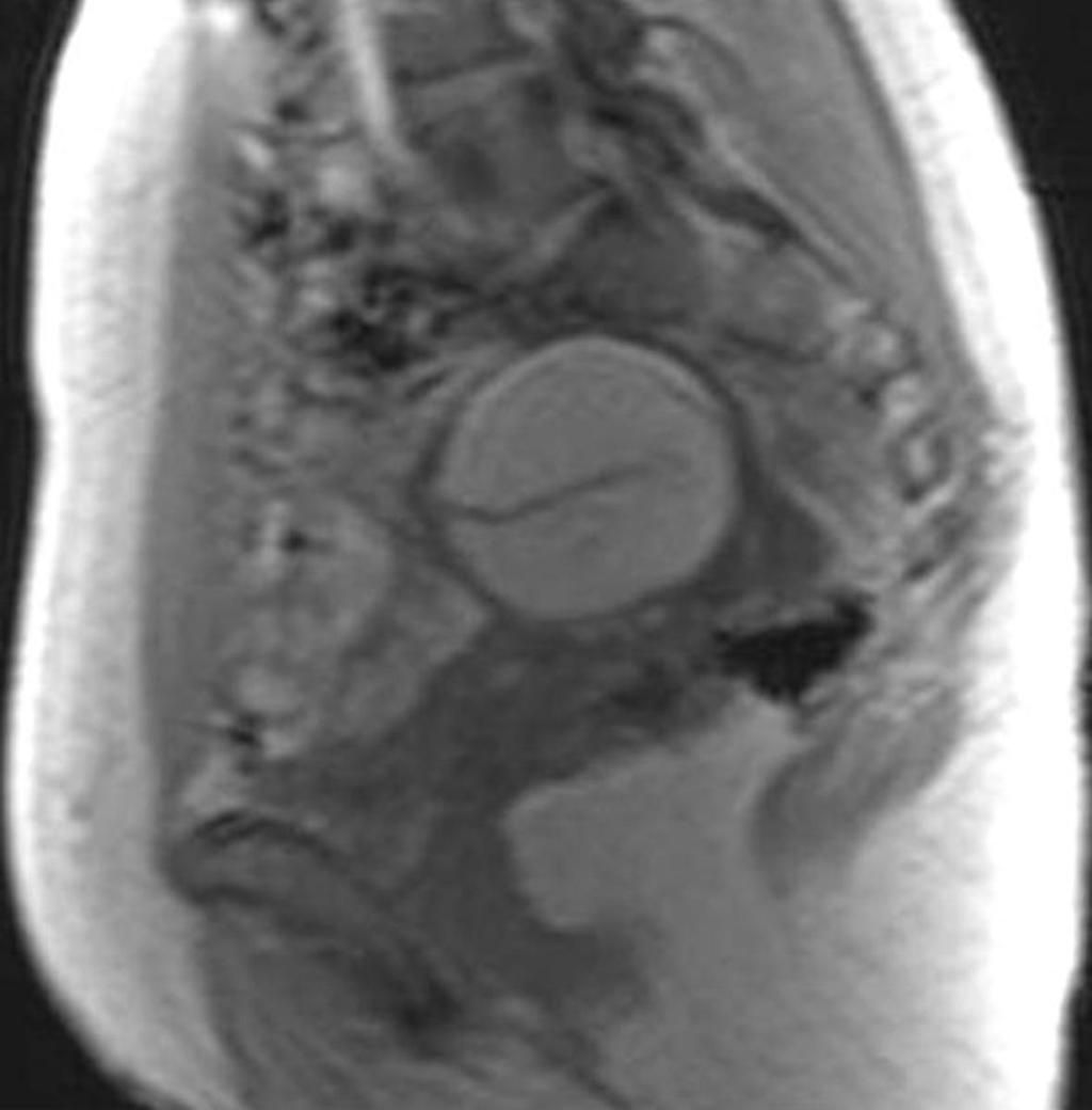 Fig. 33: Teratoma with the hemorrhage. Sagittal #1-weighted MR scan.