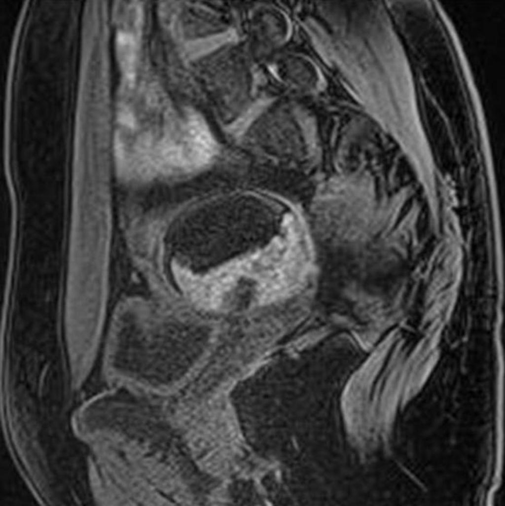 Fig. 34: Teratoma with the hemorrhage. Sagittal #2-weighted with fat suppression MR scan.