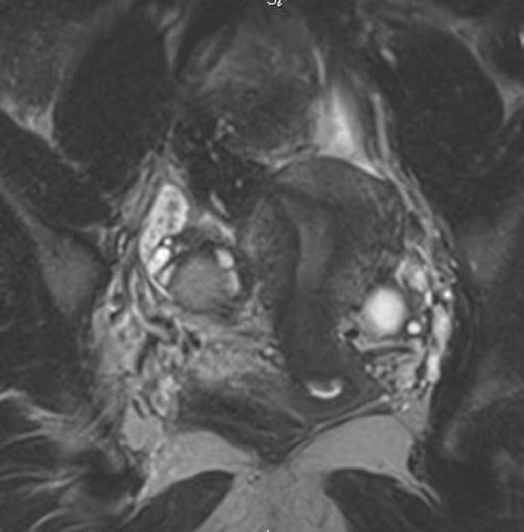 Fig. 35: Right-sided hydrosalpinx and endometrial cyst of right ovary. Coronal #2weighted MR scans show an elongated mass containing cysts with heterogenous walls and incomplete septa.
