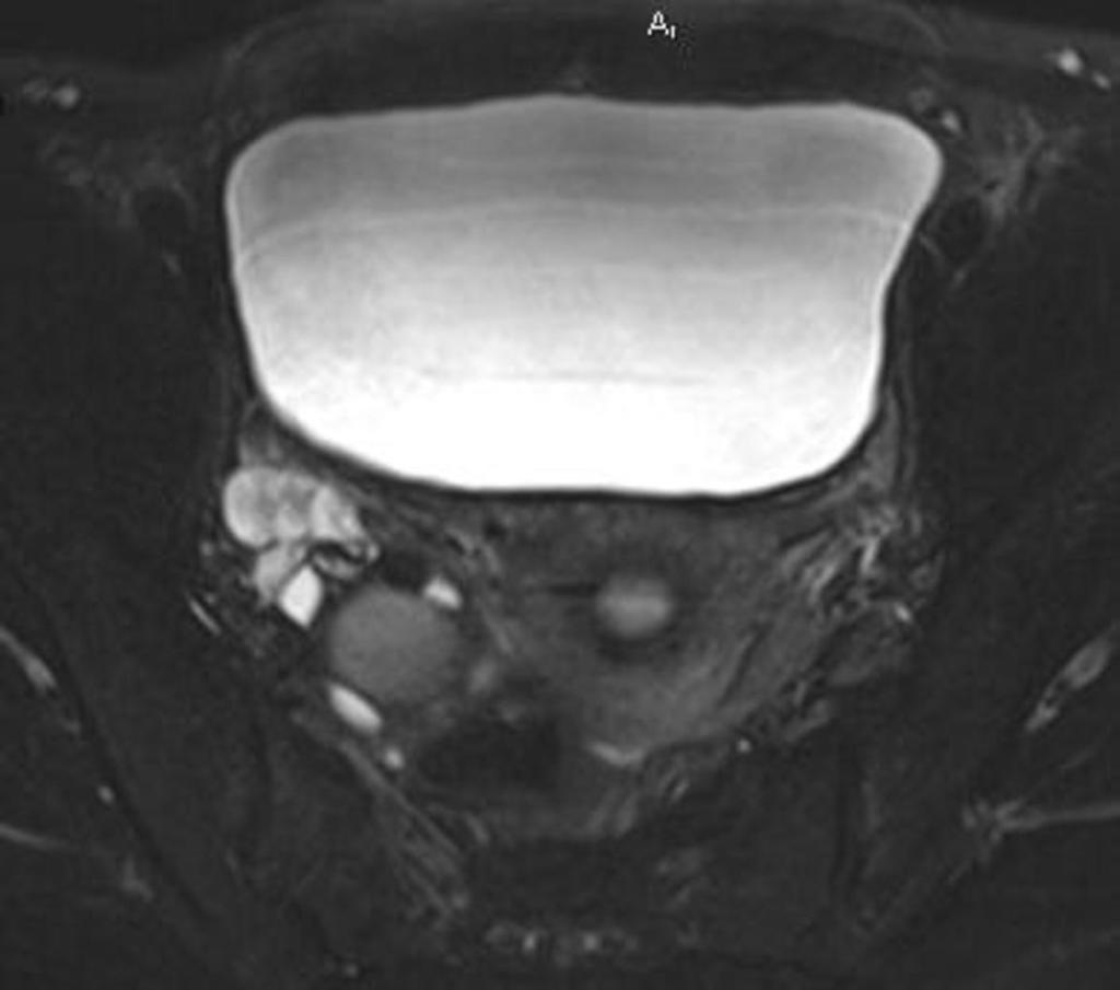 Fig. 36: Right-sided hydrosalpinx and endometrial cyst of right ovary.