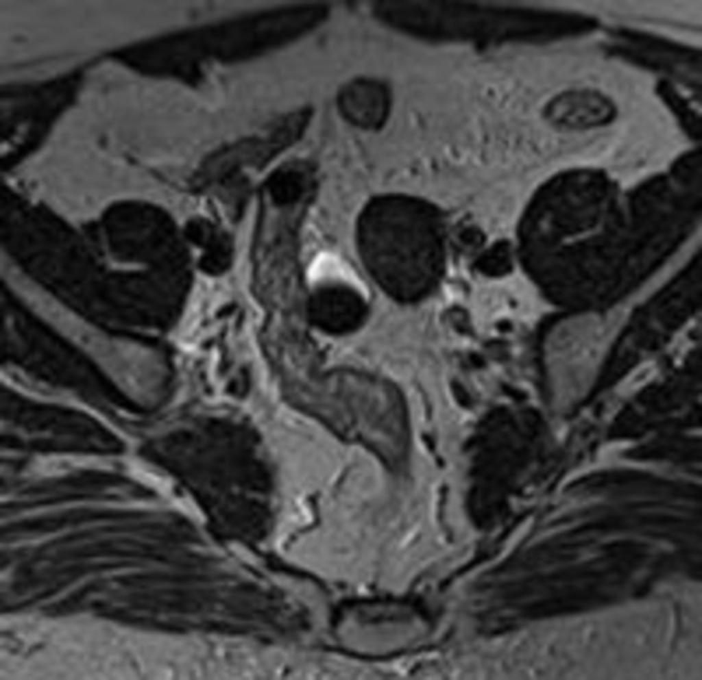 Fig. 1: A 25-year-old patient with an endometrial cyst on left ovary.