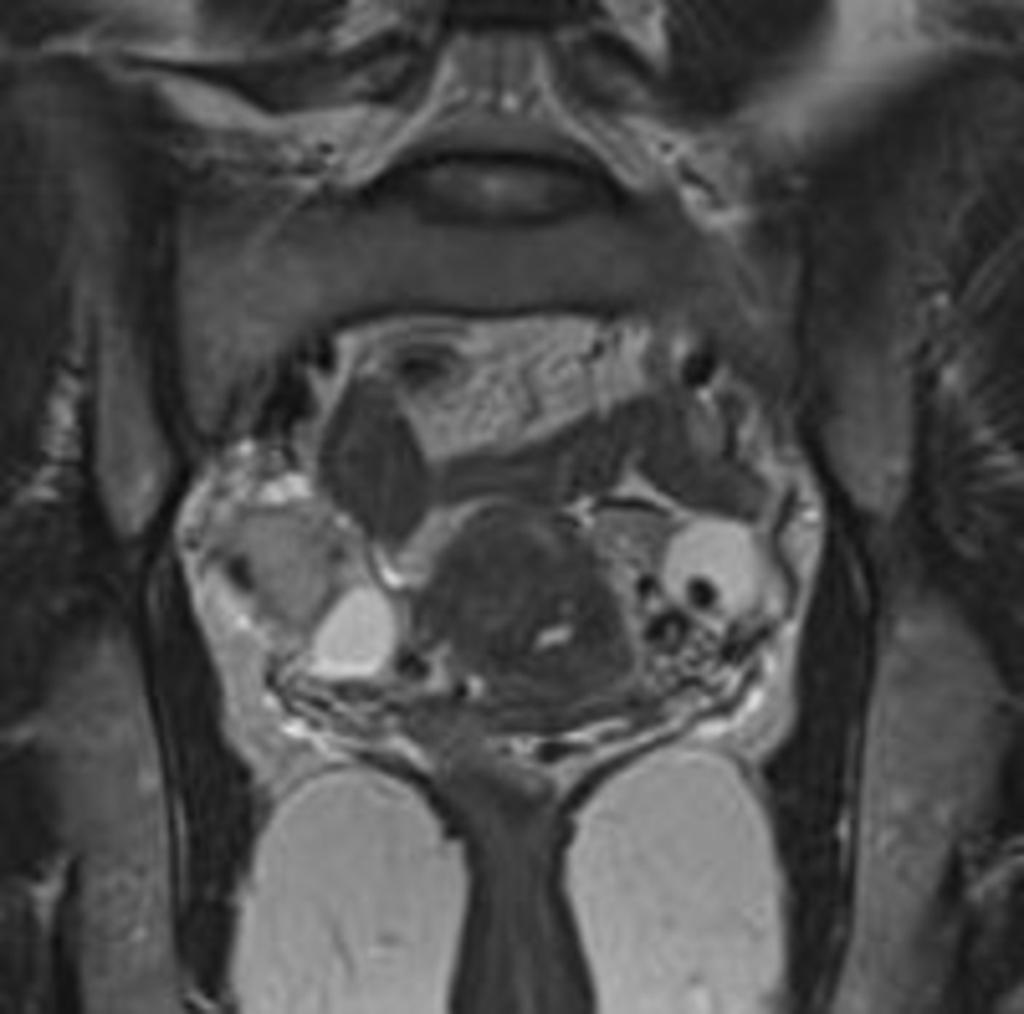 Fig. 39: Endometrial ovarian cysts. coronal #2-weighted MR images.