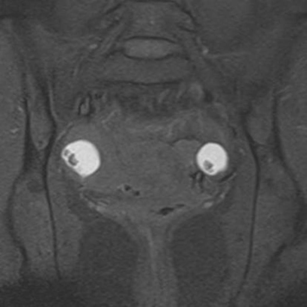 Fig. 38: Endometrial ovarian cysts. coronal #1-weighted FS MR images.