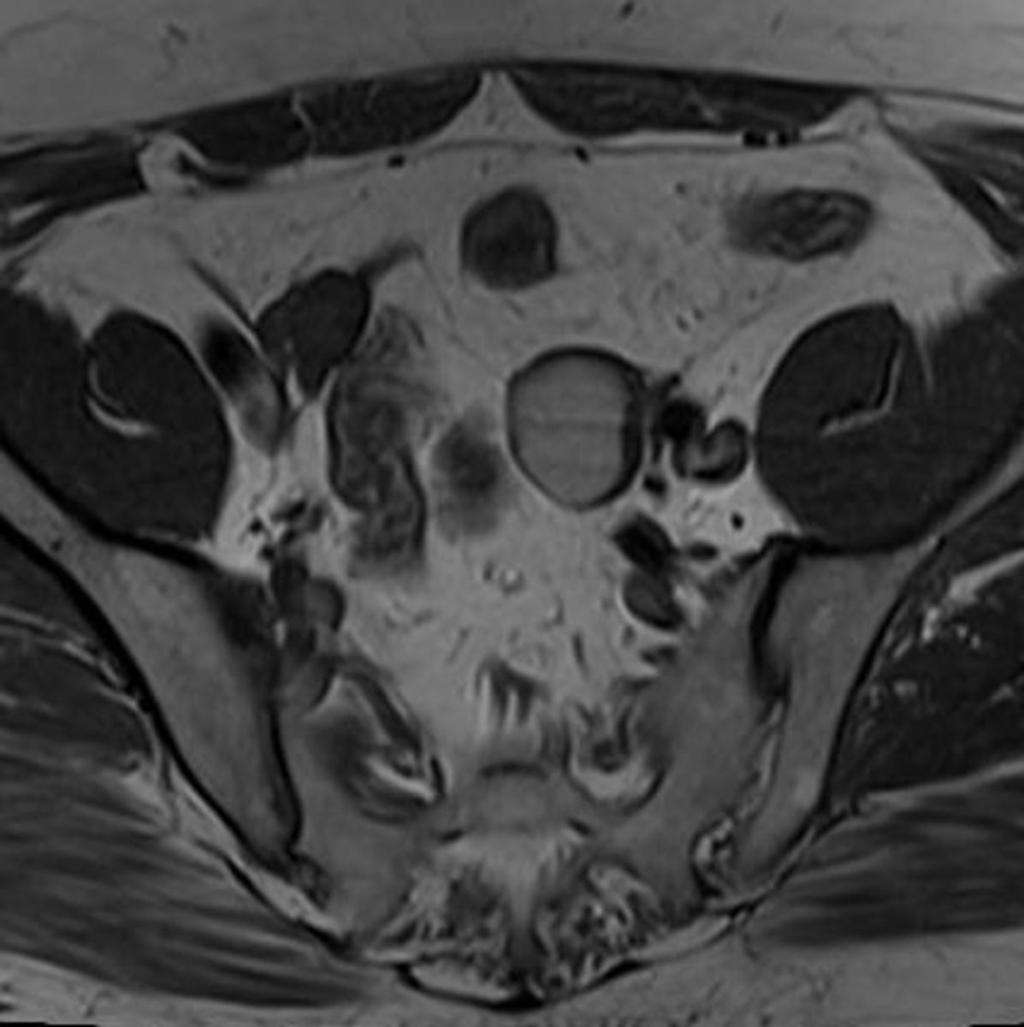 Fig. 2: A 25-year-old patient with an endometrial cyst on left ovary.