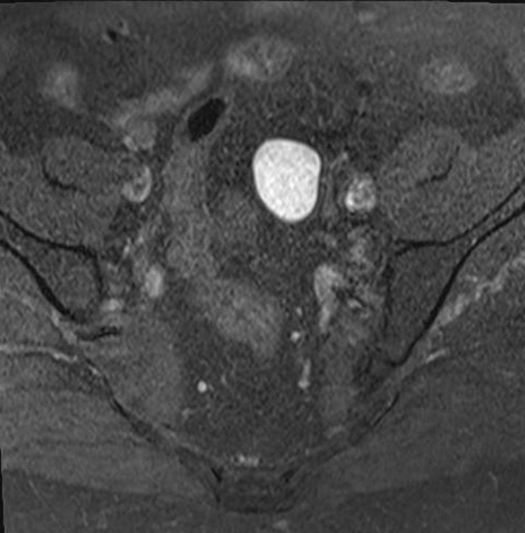 Fig. 3: A 25-year-old patient with an endometrial cyst on left