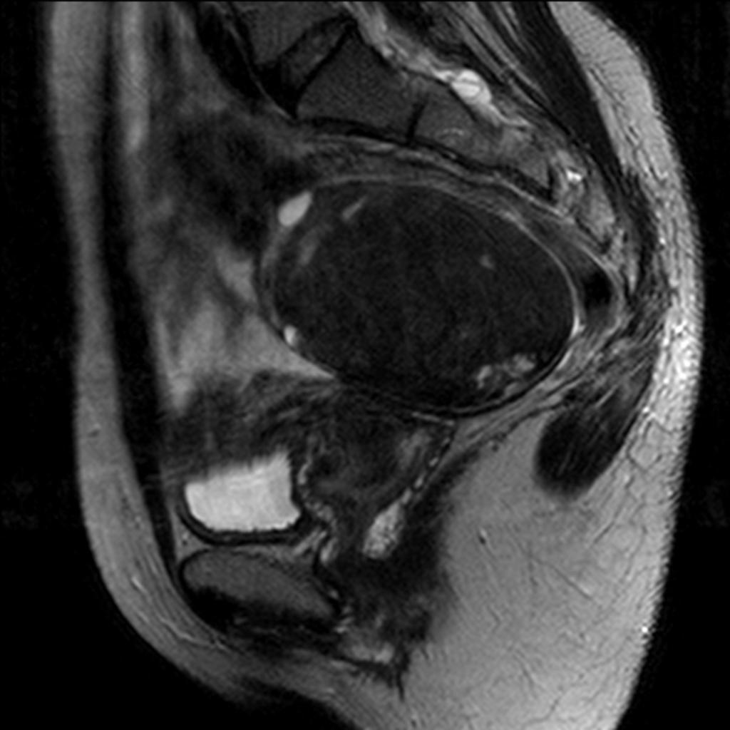 Fig. 4: A 35-year-old patient with a large endometrial cyst with the septum.