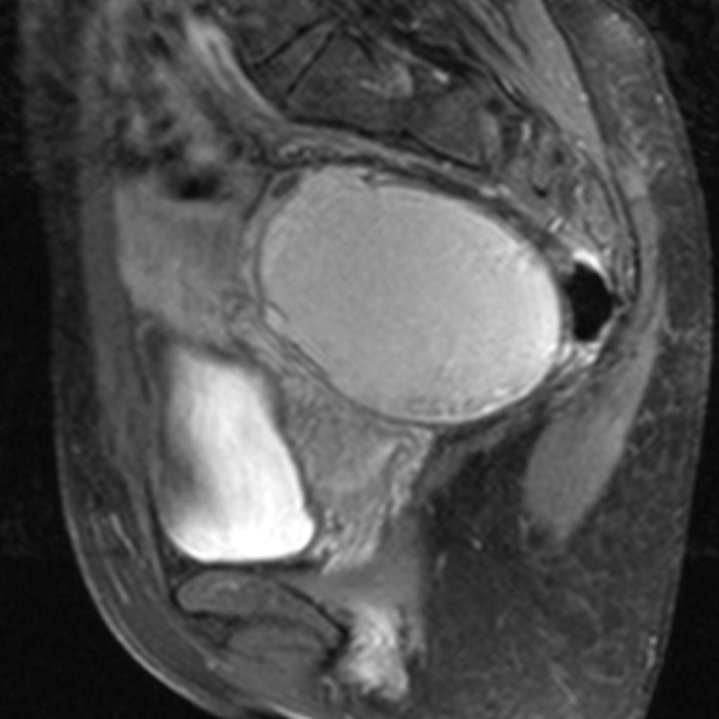 Fig. 6: A 35-year-old patient with a large endometrial cyst with the septum.