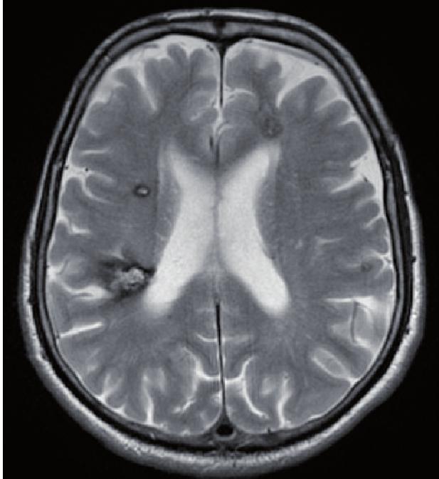 Type II lesion is shown in Figures 4, 5 and 6 with the central reticular nucleus and peripheral low-signal rim.
